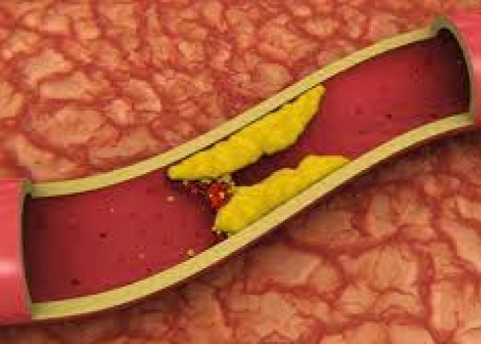 Daftar Vitamin dan Suplemen yang Sering Dipakai untuk Menurunkan Kolesterol