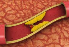 Daftar Vitamin dan Suplemen yang Sering Dipakai untuk Menurunkan Kolesterol